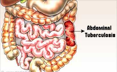 Stomach / Intestinal / Abdominal Tuberculosis