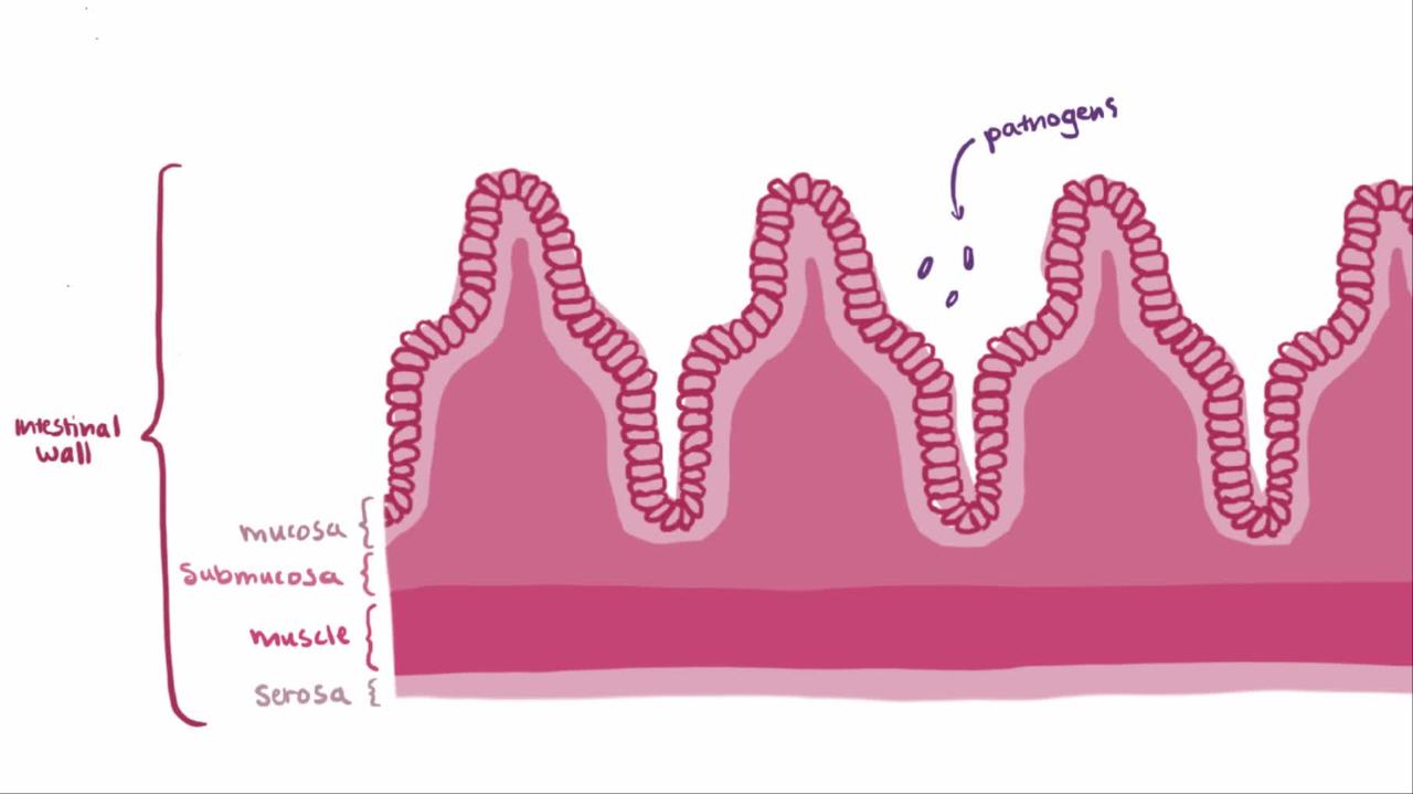 Overview of Crohn Disease