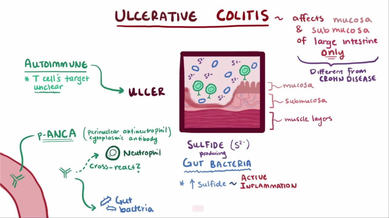 Overview of Ulcerative Colitis